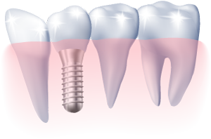 dental implant