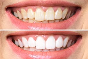 close up shot of teeth before and after teeth whitening 