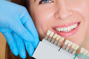 various shades of dental veneers