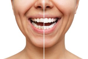 porcelain veneers before and after