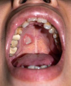 mouth sores could indicate oral cancer