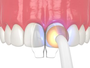 dental bonding