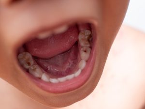 dental caries, cavities