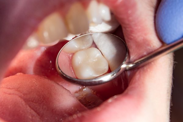 Dental exam in progress with mirror reflecting healthy teeth and gums, emphasizing comprehensive oral health assessment at Ambis Dental.