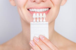 porcelain veneers