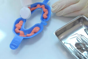 Fluoride treatment application process with pink fluoride gel in a dental tray, demonstrating preventive dental care at the Edward J. Ambis Center for Dental Medicine.
