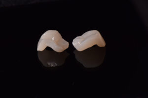inlays