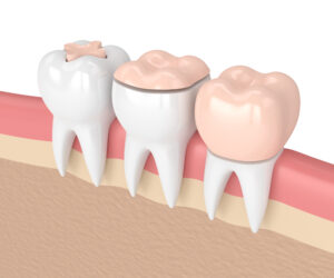 image of inlay, onlay, and dental crown