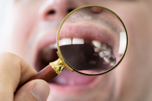 missing dental crown