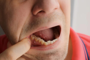 dental abscess bump