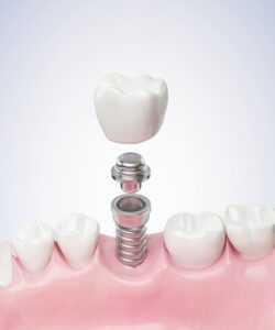 titanium dental implant