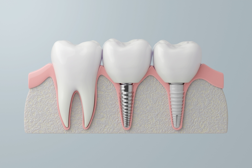 titanium vs zirconia dental implants