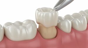 recementing dental crown