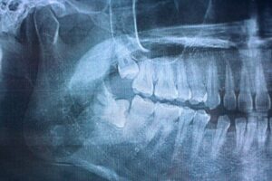impacted wisdom teeth x-ray